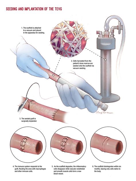 A Narrow Focus Perfecting Tissue Engineered Vascular Grafts