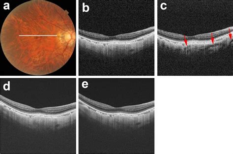 Scleral Vessel Artifacts In A Polarization Dependent Oct Image The