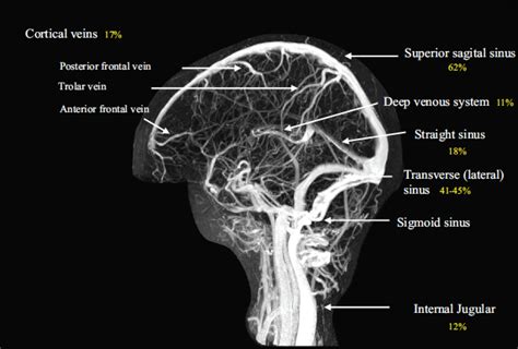 This vein is responsible for draining blood from the brain. Cerebral Venous Thrombosis - Core EM