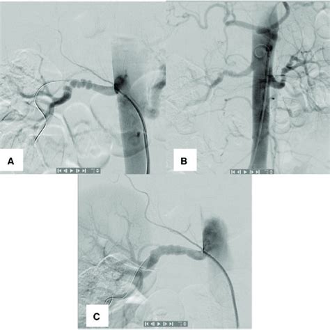 Angio Ct Fibromuscular Dysplasia On Both Renal Main Arteries More