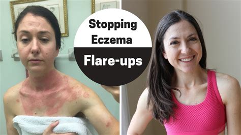 How To Handle Eczema Flare Up My 4 Step Checklist To Clear Skin Youtube