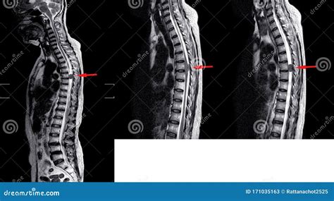 MRI Thorac Spine History Case Back Pain Radiate To Buttock And Legs Finding Intradural And