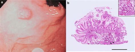 Endoscopic Appearance Of The Lesion And Histologic Features Of The