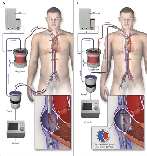 Extracorporeal Membrane Oxygenation For Ards In Adults Nejm