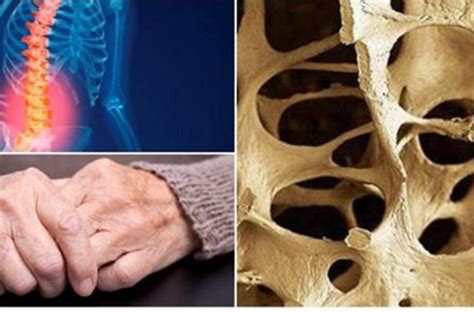 Osteoporosis Los Cuidados En El Hogar Que Debes Tener En Cuenta