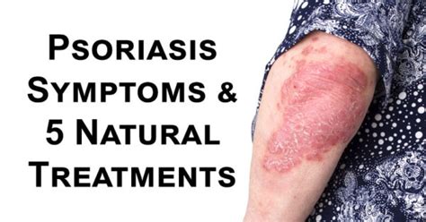 Psoriasis Symptoms And 5 Natural Treatments David Avocado Wolfe