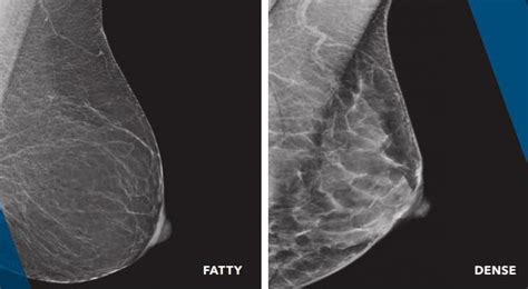 What Could Having Dense Breasts Mean Vail Health Foundation