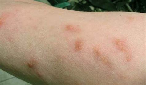Poison Ivy Rash Pictures Causes Treatment Contagious