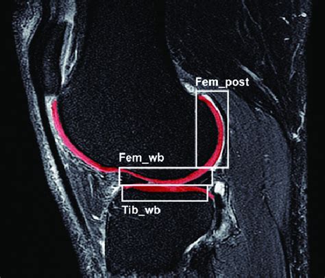 cartilage segmentation on a t2 weighted image of the lateral download scientific diagram