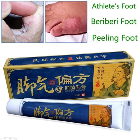 Foot Psoriasis Creams Dermatitis And Eczema Pruritus Anti Bacteria