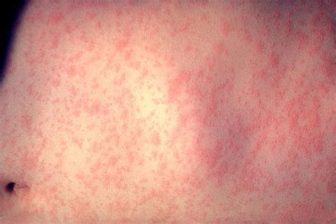 Spots And Rashes Caused By Viruses Online Dermatology