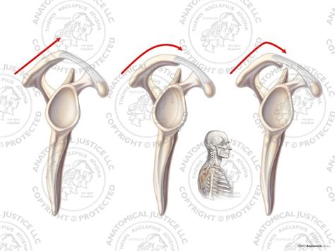 Am vorderen schulterdach befindet sich ein knochensporn der die darunter liegenden sehnen und schleimbeutel stark drückt und reizt. Bigliani Classification of the Right Acromion Process - No ...