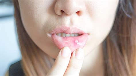 Sufferer feels discomfort and pain while it also draws excess fluid from the canker sore which allows it to dry and heal. Canker Sore Symptoms and Diagnosis | Everyday Health