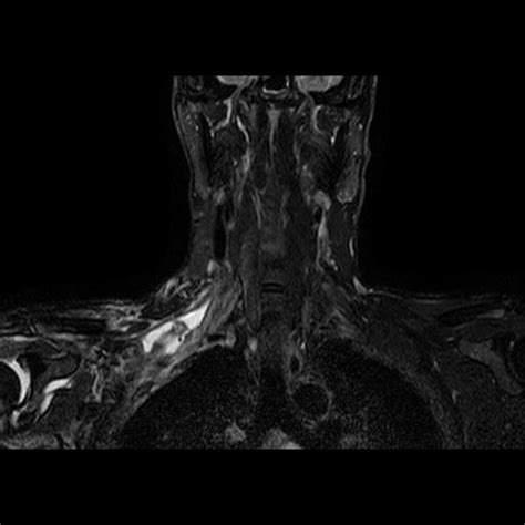 Brachial Plexus Injury Image
