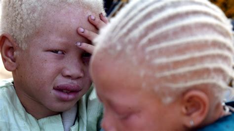 Un Resettles Albino Refugees Due To Threats In Malawi