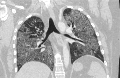 Pulmonary Alveolar Proteinosis In A Patient With Systemic Lupus
