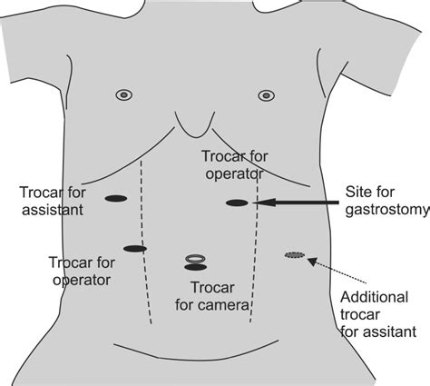 Location Of Trocars For Laparoscopic Approach To Hiatal Hernia In