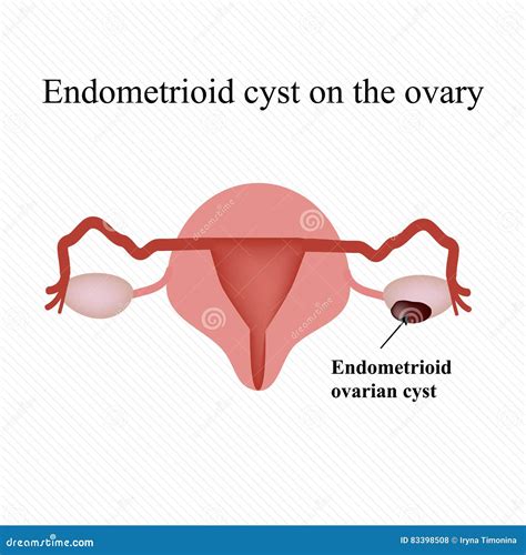 Endometrioid Cyst On The Ovary Endometriosis Ovary Infographics