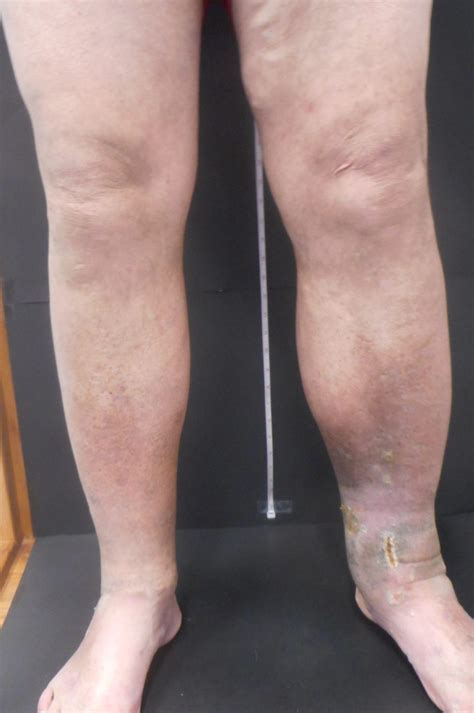 Do You Have Unexplained Swelling In Your Left Leg What Does It Mean Vein Specialists Of The