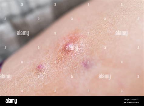 Macro Closeup Of Red Swollen Boil Pimple On Leg Skin Of Female Woman