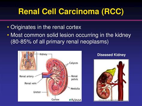 Ppt Renal Cell Carcinoma Nursing Considerations With The Use Of
