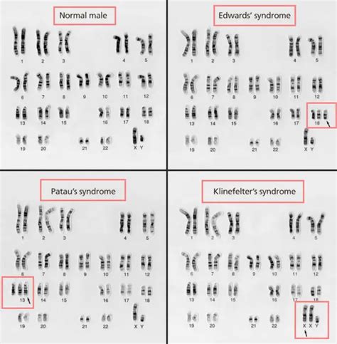Karyotyping Procedure Uses Examples Protocol Video Results