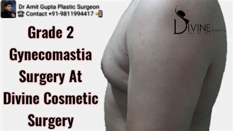 Grade Gynecomastia Surgery At Divine Cosmetic Surgery Youtube