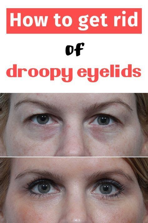Get Rid Of Saggy Eyelids For Good Remedies Well