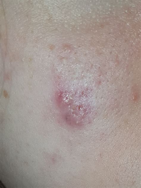 My Dermatologist Prescribed Me A Steroid Cream Fucicort To Treat This
