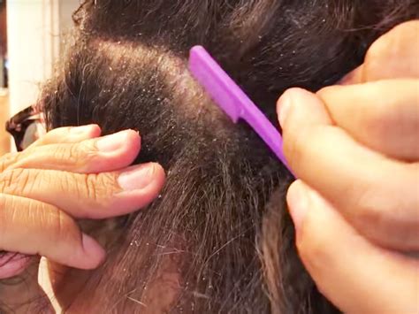 Dandruff Scraping Videos Are The New Pimple Popping Videos Self