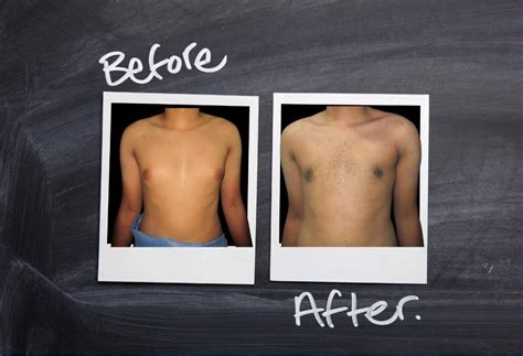 Male Breast Reduction Thrissur Gynecomastia Surgery Cost In Kerala