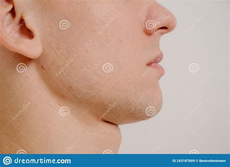 Acne Scars On The Face Stock Image Image Of Acne Melasma 243187009