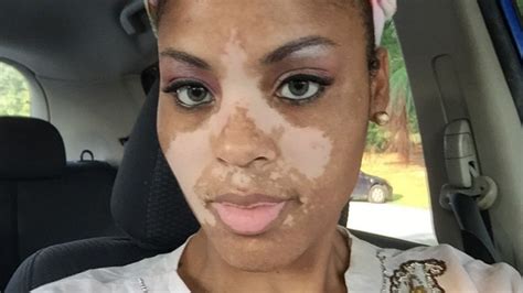 Mum With Vitiligo Embraces Rare Skin Condition Im Still A Normal
