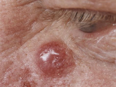 Merkel Cell Carcinoma Symptoms Causes And Treatment