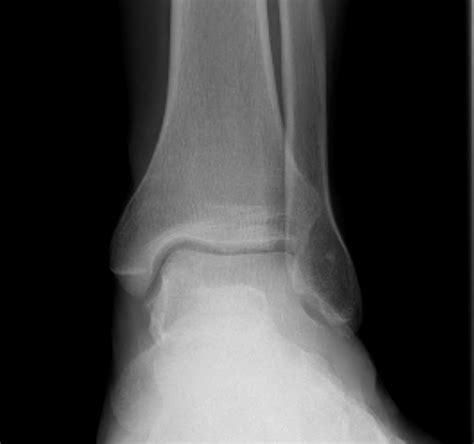 Ankle Fracture The Bone School