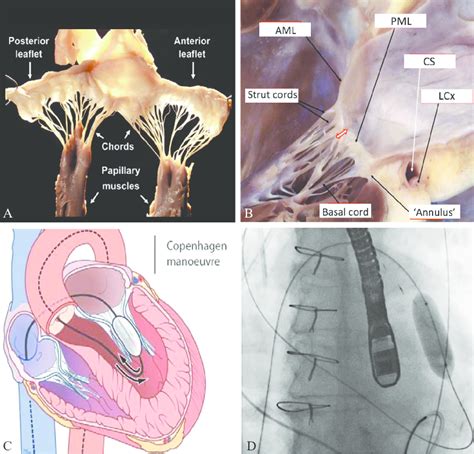 —subvalvular Apparatus A Anatomical Specimen Of Human Mitral Valve Download Scientific