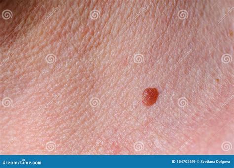 Lesion On Arm Skin Begin Scab Dried On The Epidermis Stock Photo