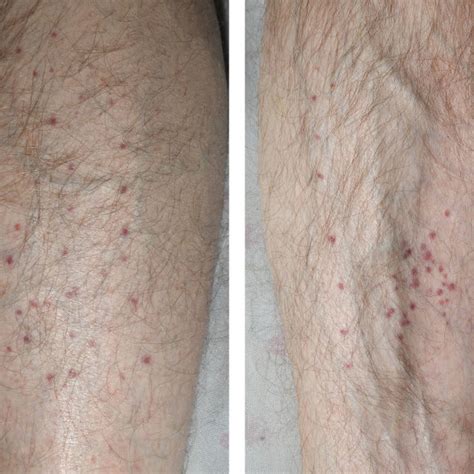 Bilateral Palpable Purpuric Rash In Hsp With Secondary Leg Oedema