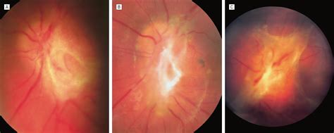 Juvenile Xanthogranuloma With Presumed Involvement Of The Optic Discand