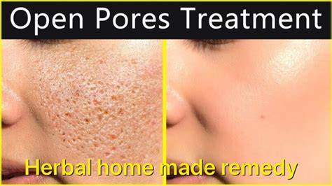 Treat Very Large Pores At Home 100 Guaranteed Results Herbal Tip
