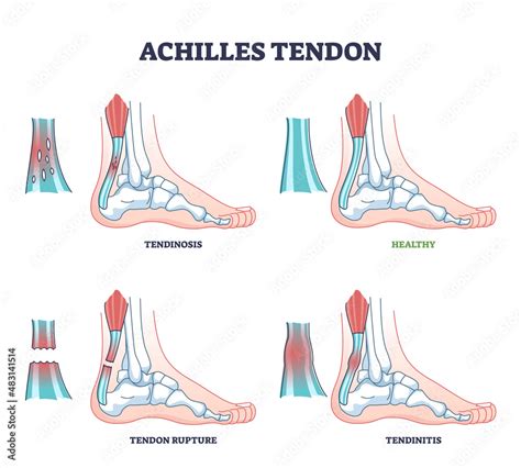 Achilles Tendon Injury As Leg Or Ankle Trauma Outline Diagram Labeled