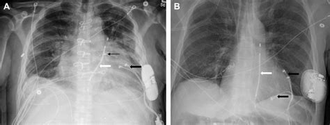 The Extravascular Cardiac Resynchronization Therapy Crt D Device