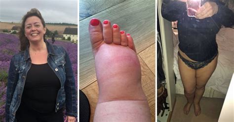 Woman With Lipoedema Will Spend Her Entire Divorce Settlement On