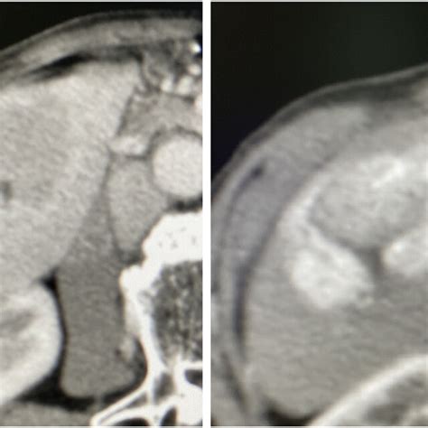 Contrast Enhanced Ct Scan Of The Abdomen Showing Liver Tumor In Segment