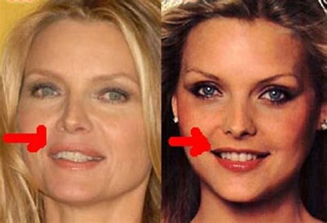 Celebrity Michelle Pfeiffer Plastic Surgery Lips Before After