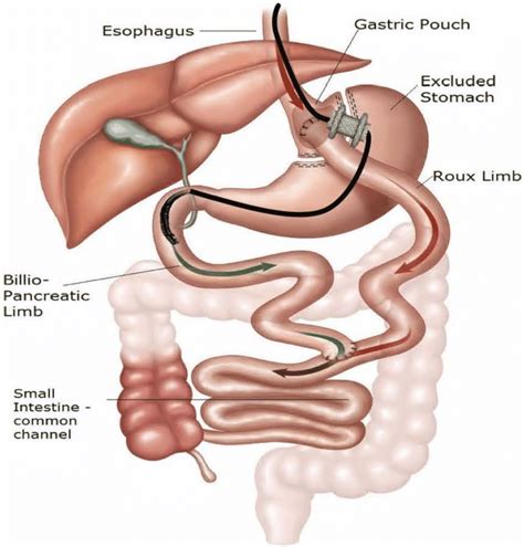 Depiction Of Endoscopic Ultrasound Directed Transgastric Ercp Edge To Download Scientific