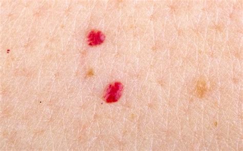 How To Remove Cherry Angiomas Red Moles The Healthy