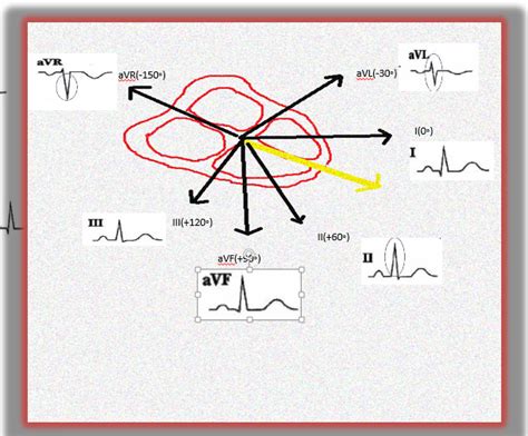 Why Should I Pay Attention To The Augmented Vector Right Avr Ekg Lead