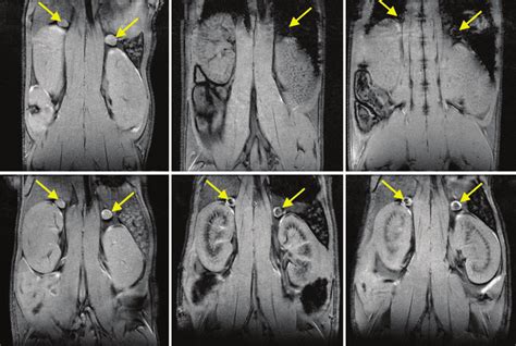 Magnetic Resonance Imaging Mri Of Adrenal Glands Before And After The