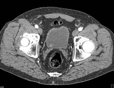 Can Ct Scan Diagnose Bladder Cancer Updated